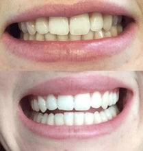 Load image into Gallery viewer, Special Offer - SNOW Teeth Whitening™ System