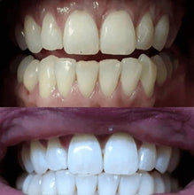 Load image into Gallery viewer, Special Offer - SNOW Teeth Whitening™ System