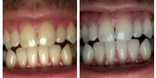 Load image into Gallery viewer, Special Offer - SNOW Teeth Whitening™ System