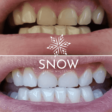 Load image into Gallery viewer, Snow® Teeth Whitening At-Home System [All-in-One Kit] - SPECIAL TV OFFER
